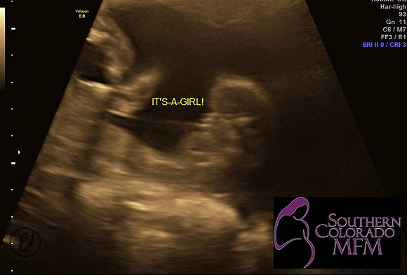 It's a Gril! 19wks